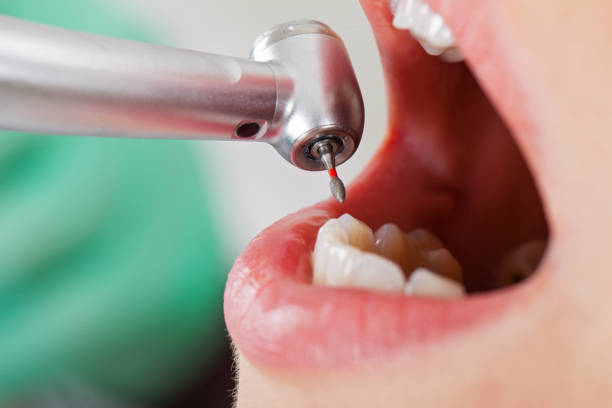 Best Emergency Wisdom Tooth Extraction in Jacksboro, TN